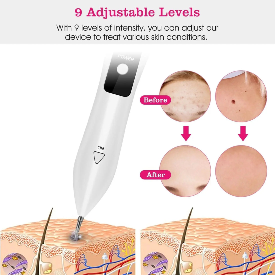 Skin Tag Repair Kit Portable Beauty Equipment Multi-Level with Home Crimson Medea