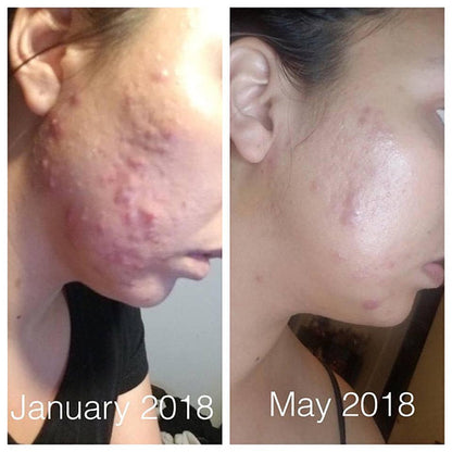 Super Acne Fighter / Organic Acne Treatment / Acne White Smokey